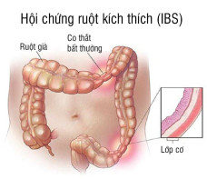 Hội chứng ruột kích thích - Giải pháp của người dân tộc Dao